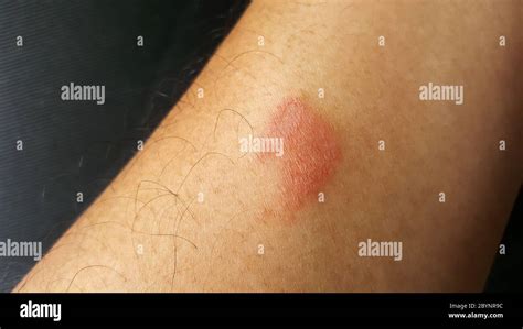 Close Up Centipede Bite Poisonous Hurt Arm Stock Photo Alamy