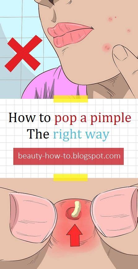 How To Pop A Pimple The Right Way Pimples Pimple Popping How To Get