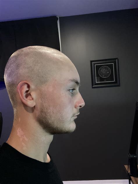 35 Shaving Head After Hair Transplant Alecsaiyanna