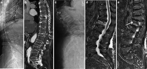 Of Vertebral Fractures Radiology Key