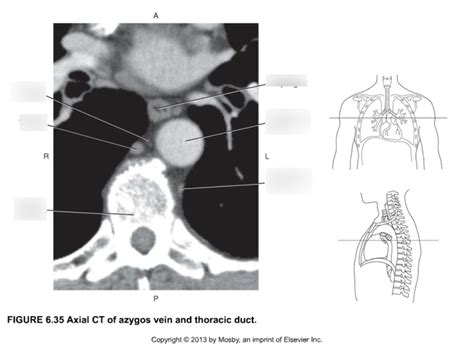 Axial Ct Of Azygos Vein And Thoracic Duct Diagram Quizlet