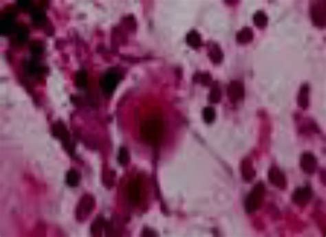 The Microscopic View Of Cells With Severe Atypia Is Shown Download