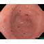 Ulceröse Gastritis – Endothek