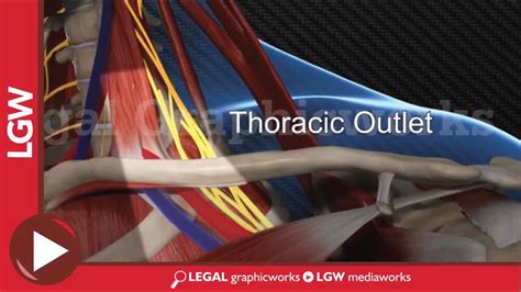 Neurogenic Thoracic Outlet Syndrome 3d Animation Youtube