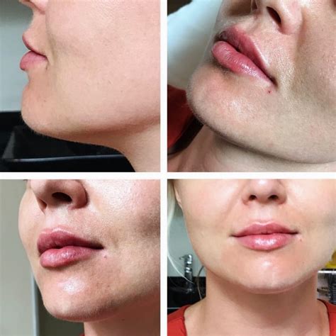 Mothlhtqqjbpqdp 05ml Lip Fillers Before And After 1ml