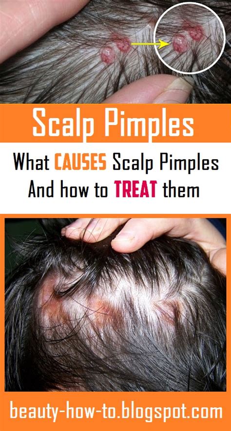 Scalp Pimples What Causes Them And How To Treat Them How To Beauty