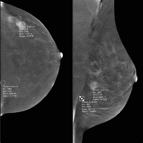 Right Breast Cancer In A 29 Year Old Woman Who Had A Palpable Lump In