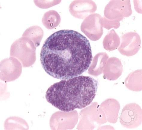 Giant Metamyelocyte 1