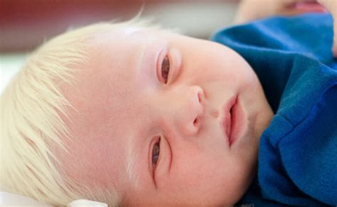 Baby Born With White Hair Is One Of The Rarest And Most