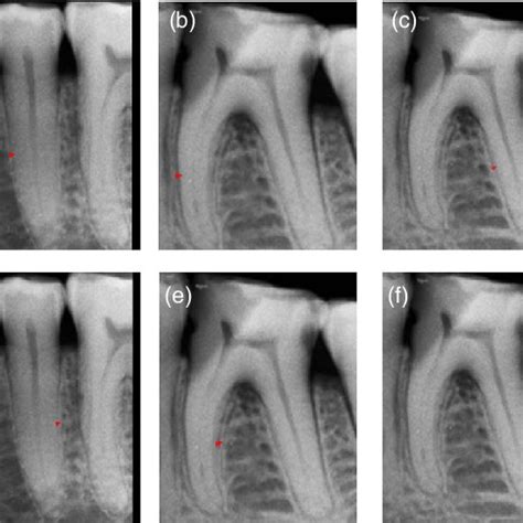 Measurement Of Periodontal Ligament Pdl Distance From The Mid Triple