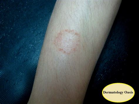 Nummular Eczema Dermatology Oasis