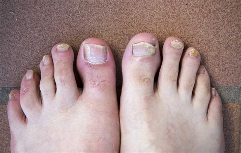 All You Need To Know About Fungal Nails Farnham Foot Clinic