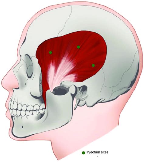 Temporalis Muscle Recommended Injection Sites Download Scientific Diagram