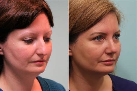 lip augmentation before and after photos page 2 of 6 the naderi center for plastic surgery