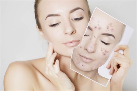 4 Must Have Skin Care Products For Acne Prone Skin 2020