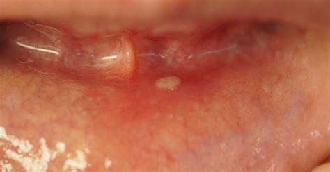 Dishing The Details Decoding The White Stuff In A Canker Sore