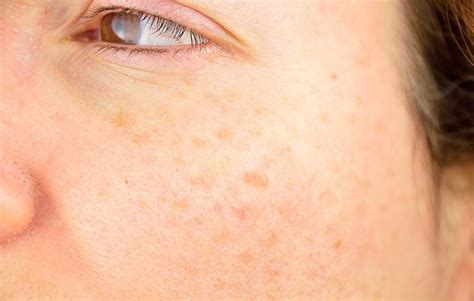 How To Get Rid Of Dark Spots According To Dermatologists Best Dark