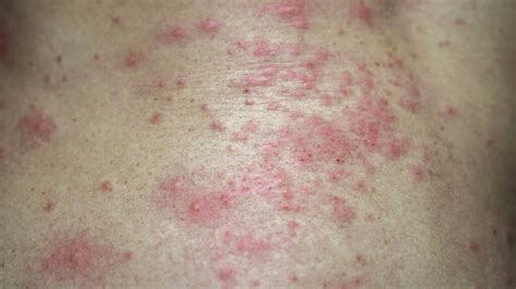 Bacterial Skin Rash Causes Remedies And Treatments Revealed