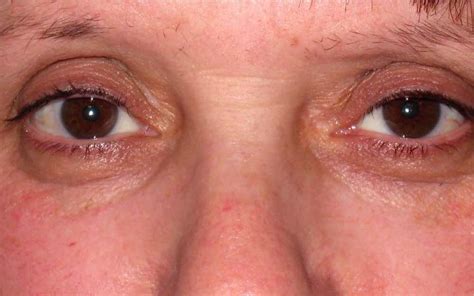 Yellowing Under The Eyes Infoupdate Org