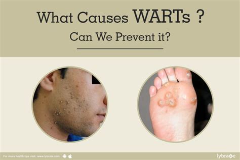 What Causes Warts Can We Prevent It By Dr Akhilendra Singh Lybrate