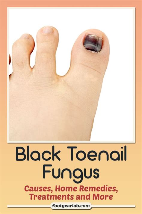 Black Toenail Fungus Causes Home Remedies Treatments And More