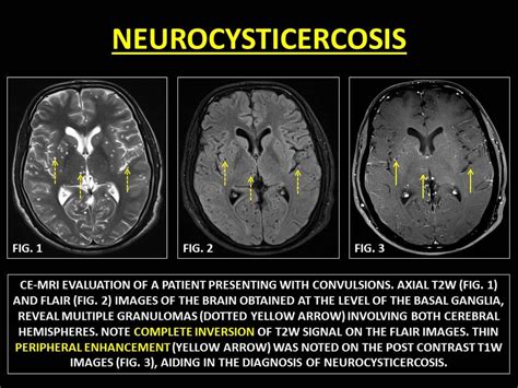 Neurocysticercosiswhat To Know