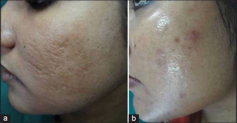 A Grade 3 Acne Scars B Improvement In Acne Scars From Grade 3 To