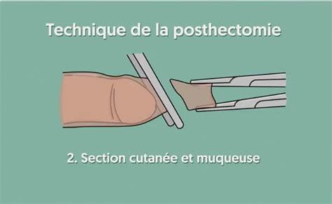 Circoncision Comment ça Se Passe Vidéo Intégrale Lmdm