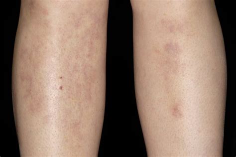 Erythema Nodosum What Are The Signs And Symptoms Patient Talk