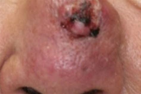 Mohs Surgery For Basal Cell Carcinoma Squamous Cell Carcinoma