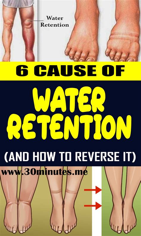 Causes Of Water Retention And How To Reverse I