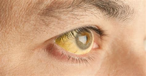Vitamin B12 Deficiency Signs Three Ways Your Eyes Can Show Advanced