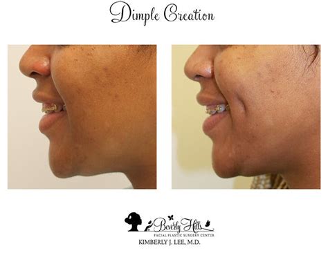 Dimple Creation Los Angeles Dimpleplasty Beverly Hills