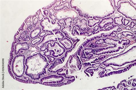Intestinal Polypoid Adenoma Light Micrograph Photo Under Microscope