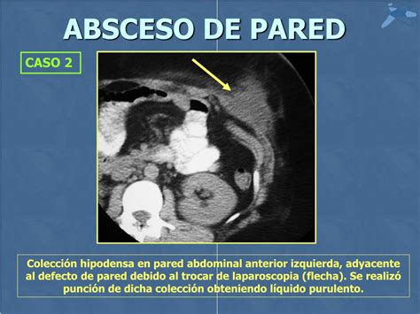 Ppt Absceso De Pared Abdominal Powerpoint Presentation Free Download Id 730680
