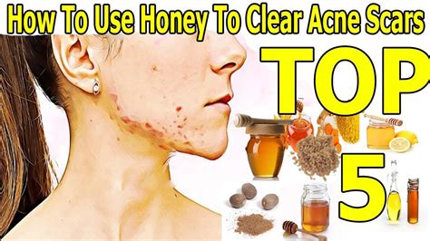 How To Use Honey To Clear Acne Scars Youtube