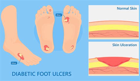 4 Stage Therapy Concept Avoid Amputation Due To Diabetic Foot Ulcer