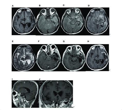 Brain Mri Findings After The Second Surgery On December 4 2019 A