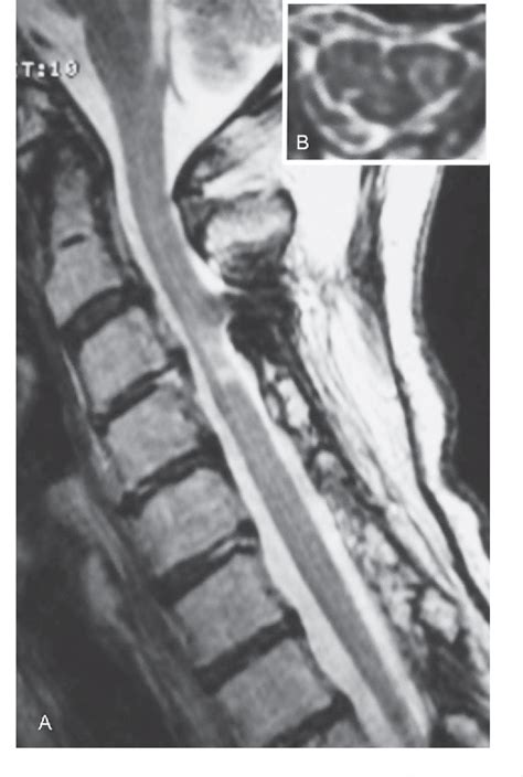 Figure 1 From Spinal Segmental Myoclonus During Postural Maintenance In