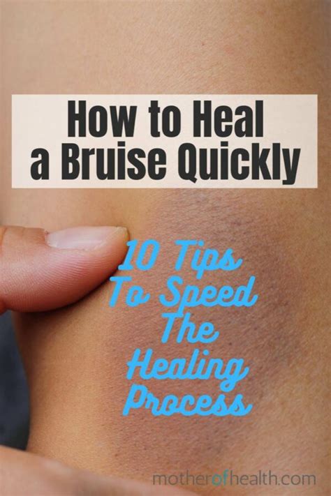 How To Heal A Bruise Quickly And Naturally Mother Of Health