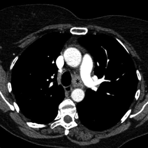 A‐c Axial Chest Ct Images Showing Linear Reticular Subpleural