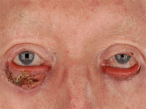 Extensive viral warts (usually in immunosuppressed patients) circulatory problems. Pityriasis rubra pilaris (PRP)