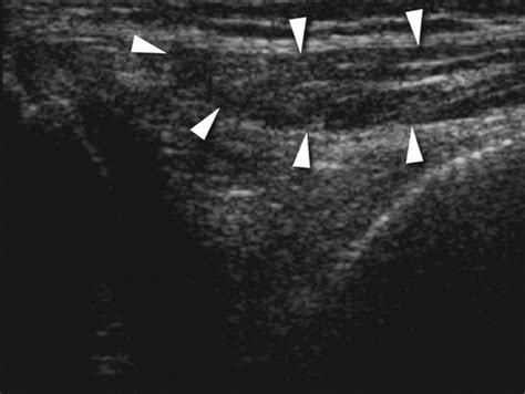Medial Plica Syndrome Of The Knee Diagnosis With Dynamic Sonography