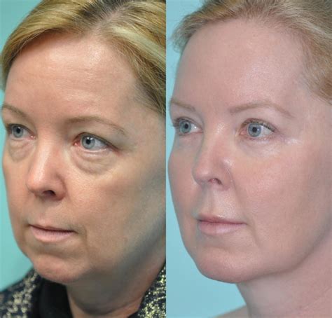 Blepharoplasty Photos Chevy Chase Md Patient 11850