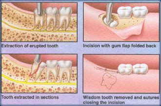Whether You Need Your Wisdom Teeth Cared For Or A Tooth Extraction In