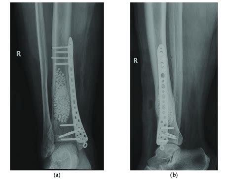 Curettage Bone Substitute Grafting And Plate Osteosynthesis After