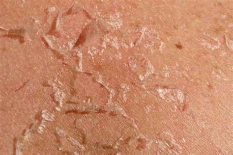Sunburned Human Skin Peeled Peeling Stock Photos Pictures And Royalty