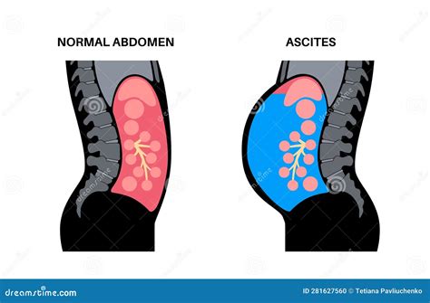 Ascites Disease Poster Vector Illustration 281627560