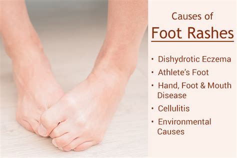 Foot Rashes Causes Treatment And Home Remedies 2022