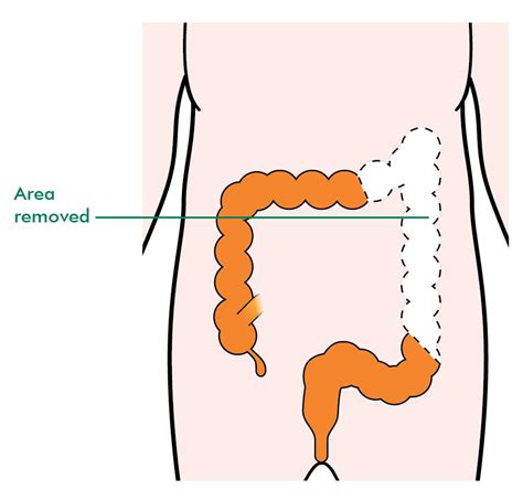 Types Of Surgery For Colon Cancer Information And Support Macmillan Cancer Support